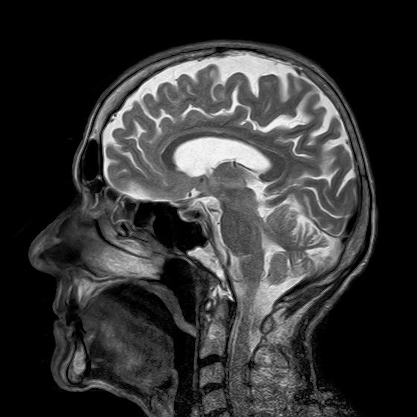 MRI OF THE BRAIN