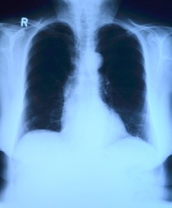 an xray of healthy lungs with no signs of pneumonia. 