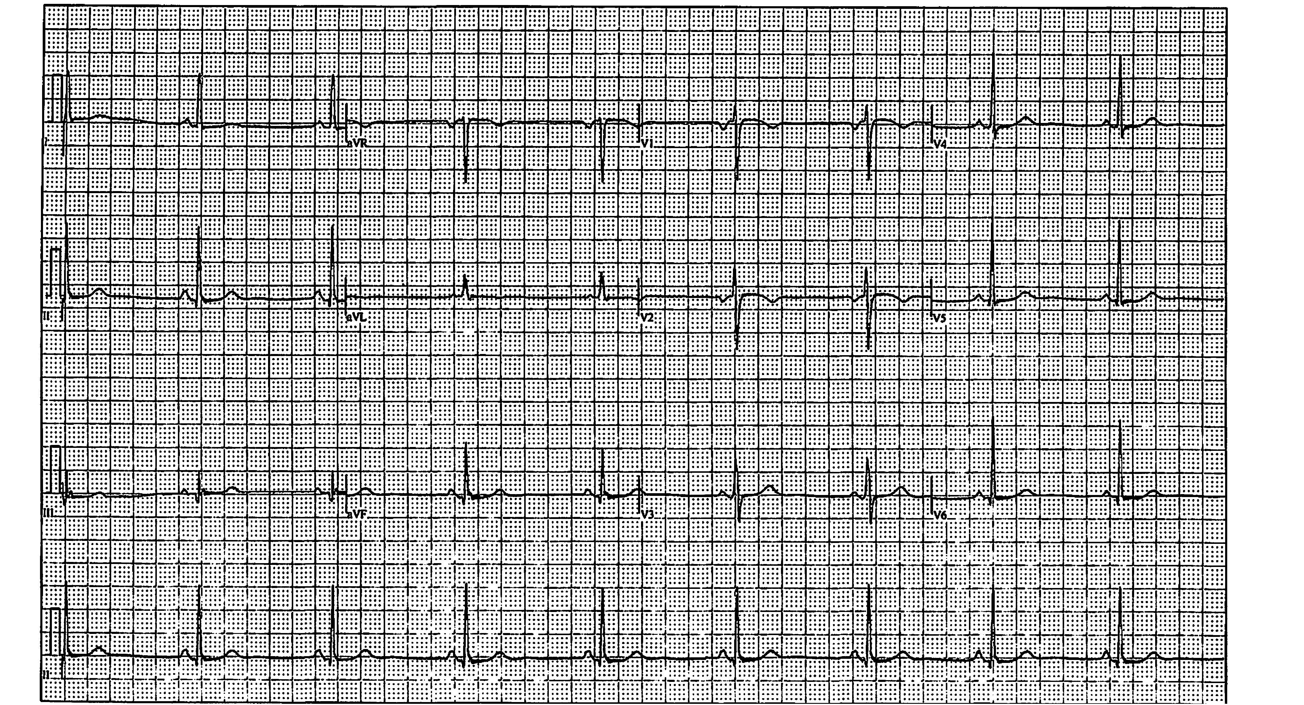 electrocardiogram- tracing