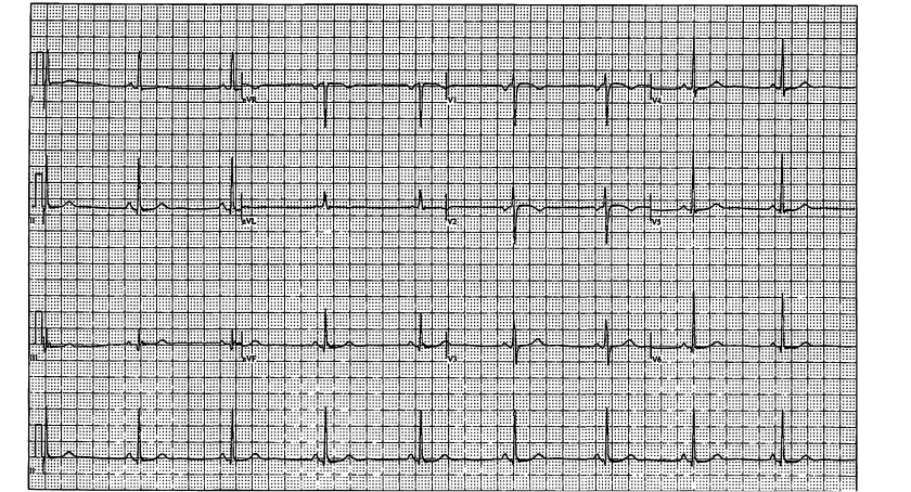 electrocardiogram- tracing