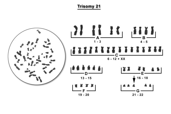 Trisomy 21 chromosomes