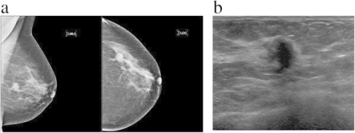 a mammogram image