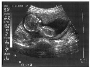 ultrasound image of a 4 month old fetus