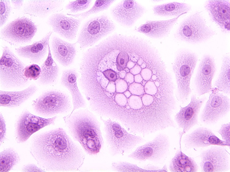 a microscope image of a cell infected with HPV 