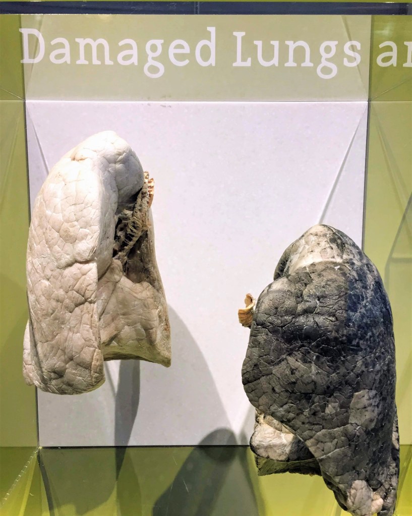 2 preserved human lungs, one normal, one damaged