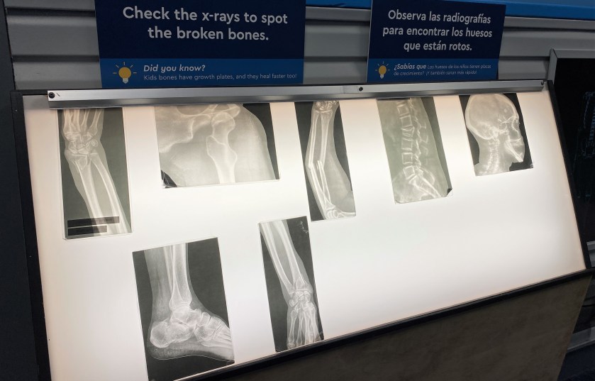 xrays of various bones showing fractures